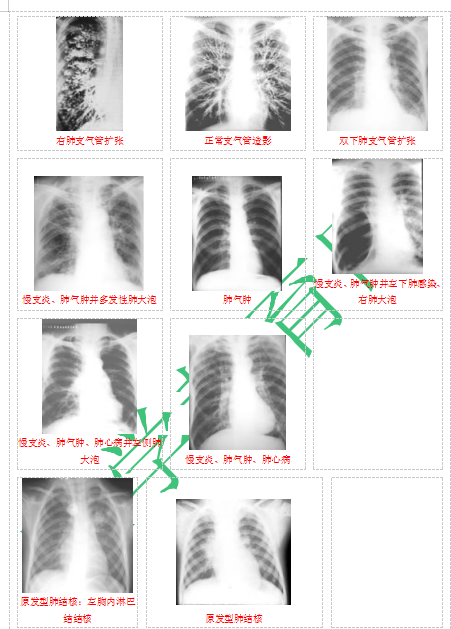 快收藏！臨床助理醫(yī)師實(shí)踐技能62個(gè)胸片（圖片診斷）