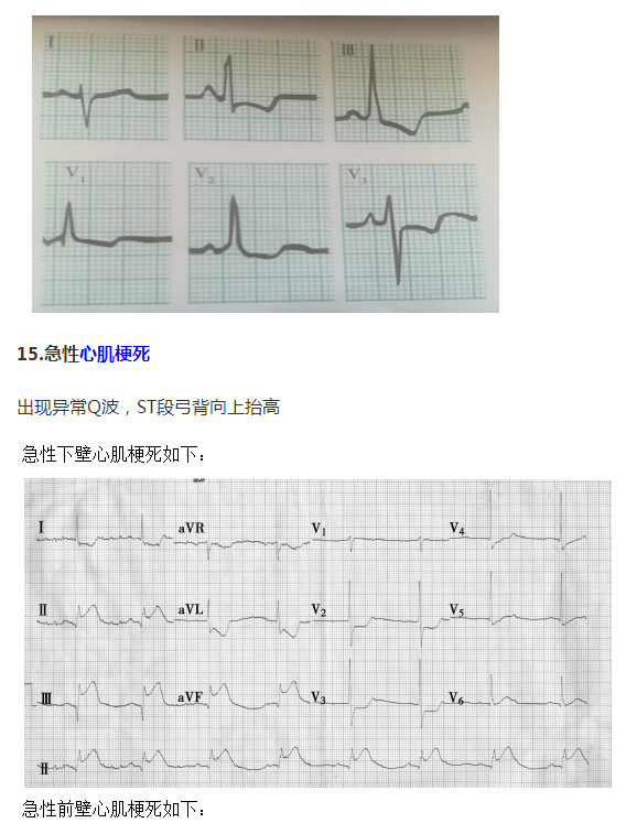 急性心肌梗死