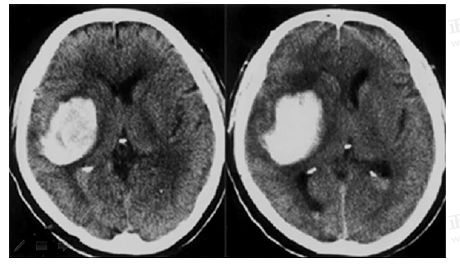 男55歲，左側(cè)肢體偏癱4小時(shí)，有高血壓史，診斷為